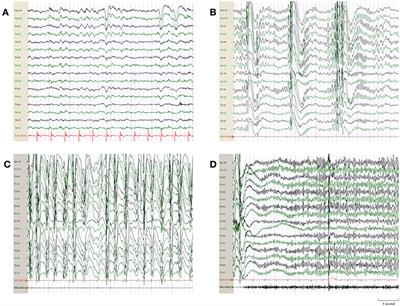 Quinidine Therapy for Lennox-Gastaut Syndrome With KCNT1 Mutation. A Case Report and Literature Review